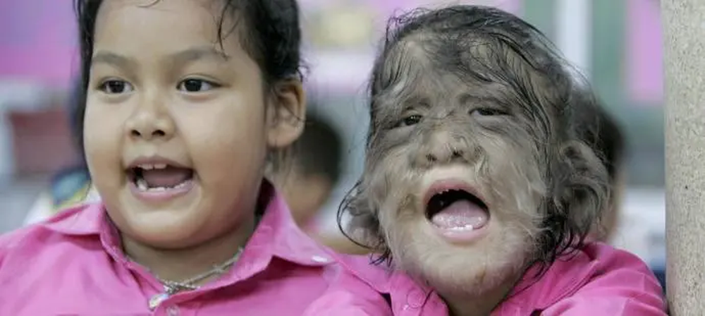 Un niño con el síndrome del hombre lobo