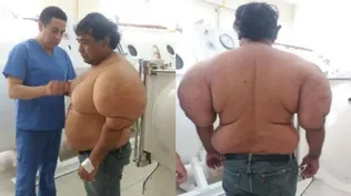 El extraño caso del buzo que tiene el cuerpo inflado desde 2013