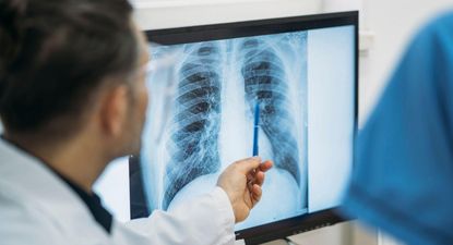 Qué es un adenocarcinoma pulmonar, el tipo de tumor maligno que le extirparon al papa León XIV