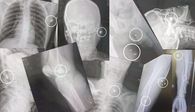 Radiografías de heridos de bala ingresados al hospital del Cerro