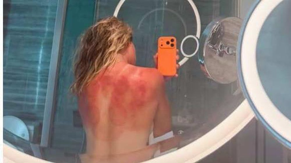 "El sol de Australia no es broma": la foto de una tenista mexicana que muestra el riesgo en el país con las tasas de cáncer de piel más altas del mundo