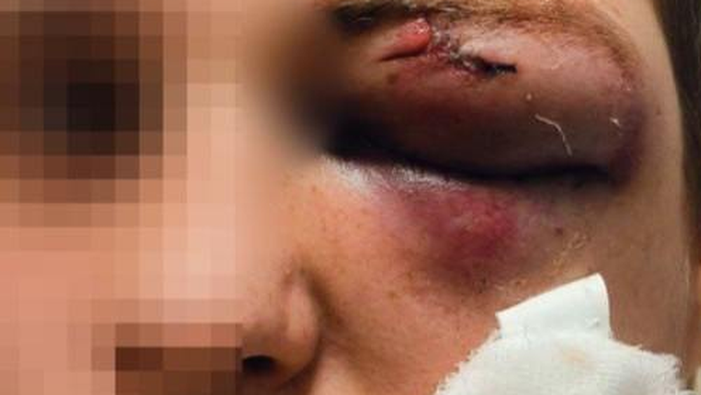Los médicos no pudieron salvar el ojo de Yaroslav tras el ataque.