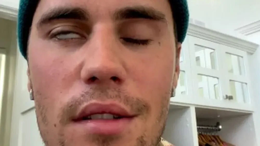Bieber muestra los efectos del síndrome de Ramsay Hunt
