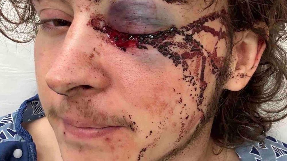 Kaden Rummler dice que quedó permanentemente tuerto.