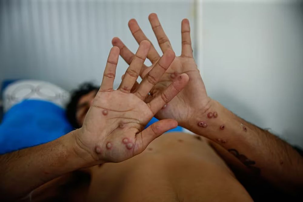 No existe un tratamiento específico para la enfermedad. La notificación oportuna de casos confirmados y probables es importante para detener la expansión del virus.