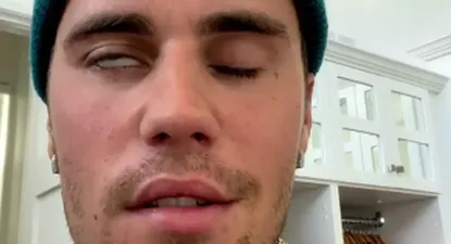 Bieber muestra los efectos del síndrome de Ramsay Hunt