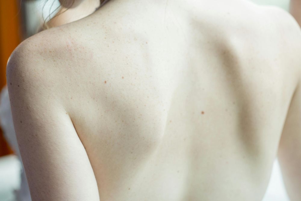 En etapas avanzadas, el tratamiento del cáncer de piel puede incluir cirugía radical, radioterapia o quimioterapia.