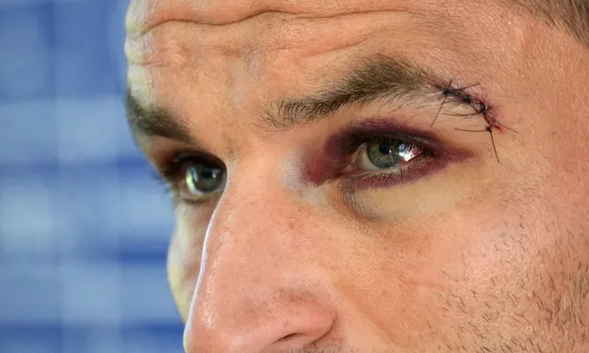 Gonzalo Bergessio con el ojo lastimado en la conferencia de prensa previa al clásico