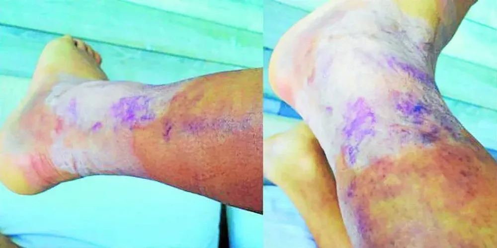 El tobillo de Alexis Sánchez luego de la patada de Mercado