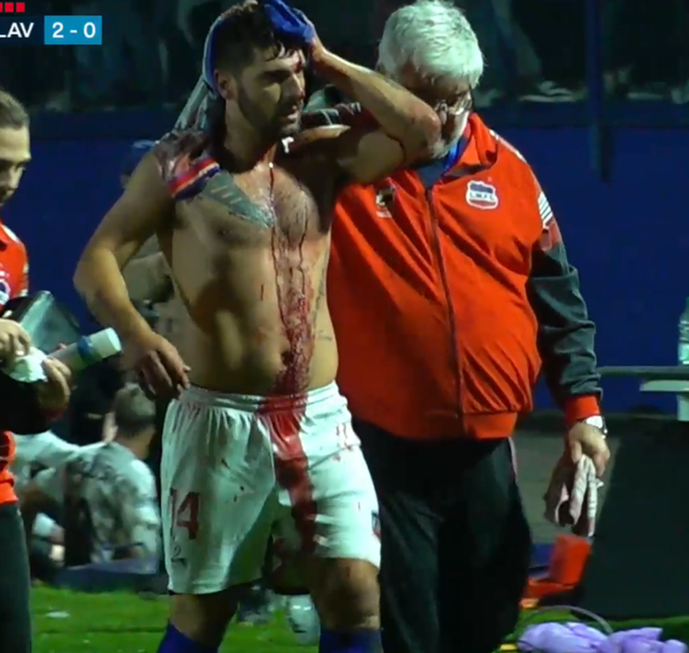 Así terminó un jugador de Lavalleja tras el título de San José por la Copa Nacional de Selecciones de OFI