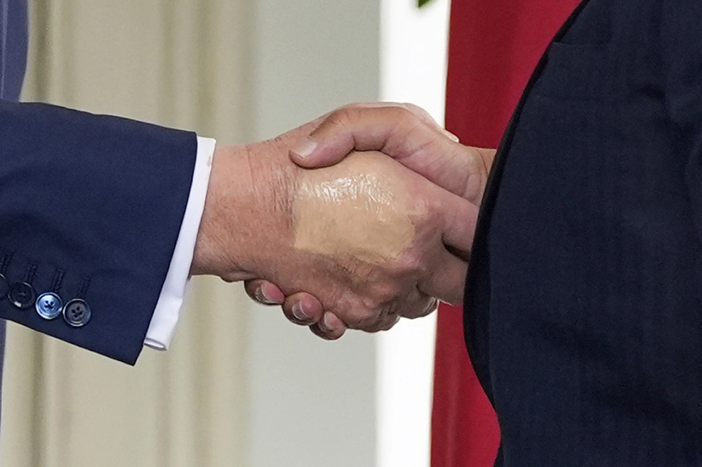 Trump intentó cubrir sus moretones con maquillaje espeso.