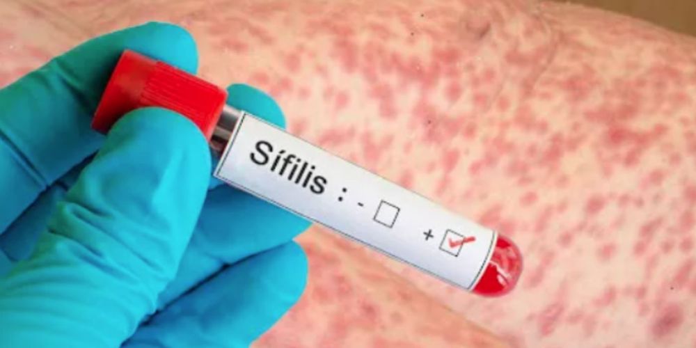 SÍFILIS EN ARGENTINA