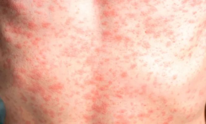 Detectaron caso de sarampión autóctono en San Javier: MSP desplegará operativo y habrá clases virtuales en la localidad