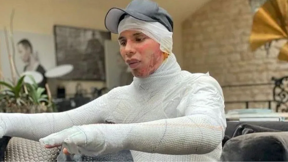 Rousteing La foto de Instagram de Olivier Rousteing muestra las lesiones que sufrió el año pasado, dijo el diseñador