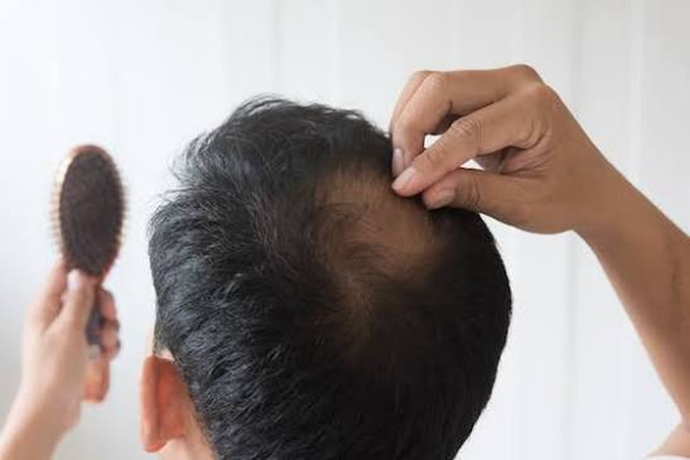 Alopecia severa