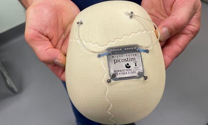 El dispositivo que le implantaron al chico inglés que sufre un tipo de epilepsia muy severo.