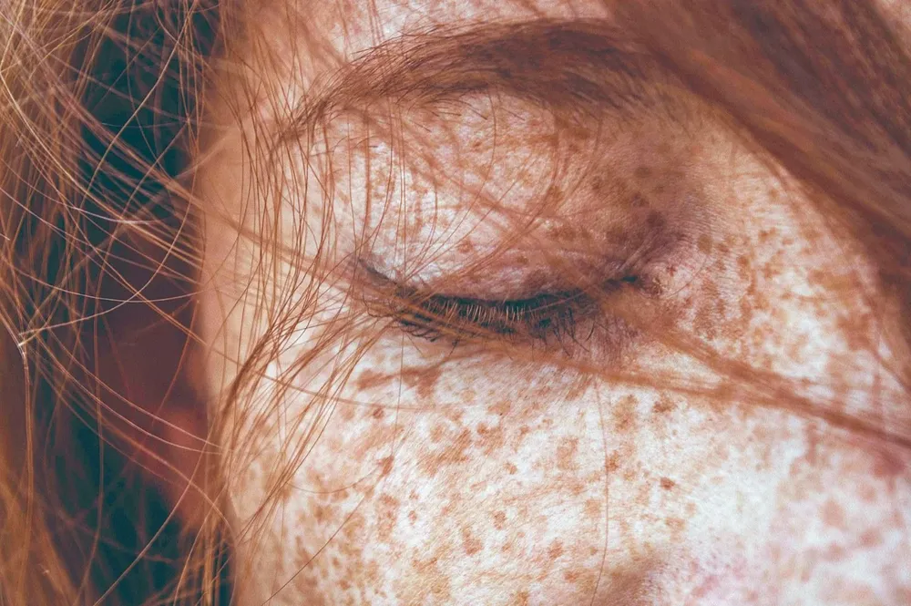 La mayoría de los lunares son inofensivos