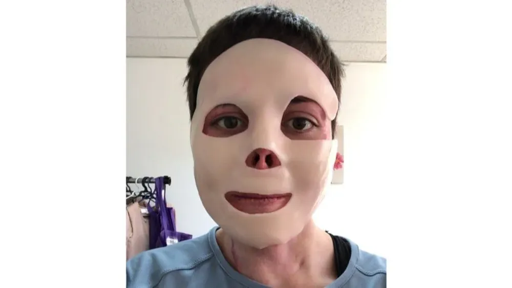 Noelia Tabilo terminó con el 70% de su cuerpo y el 40% de sus vías respiratorias totalmente quemadas tras el incendio.