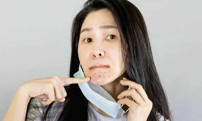 Coronavirus: cómo lidiar con el maskne, el acné por el uso de tapabocas