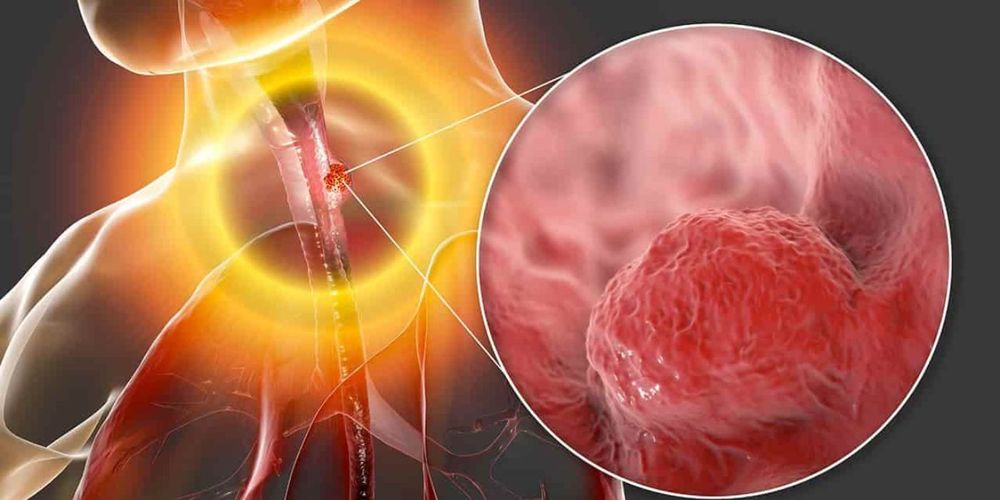 CÁNCER DE ESÓFAGO.jpg