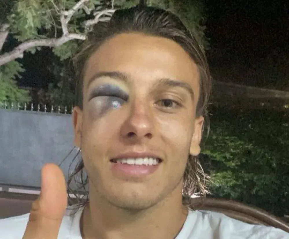 Así quedó el rostro de Agustín Canobbio tras el cabezazo involuntario que recibió ante Danubio