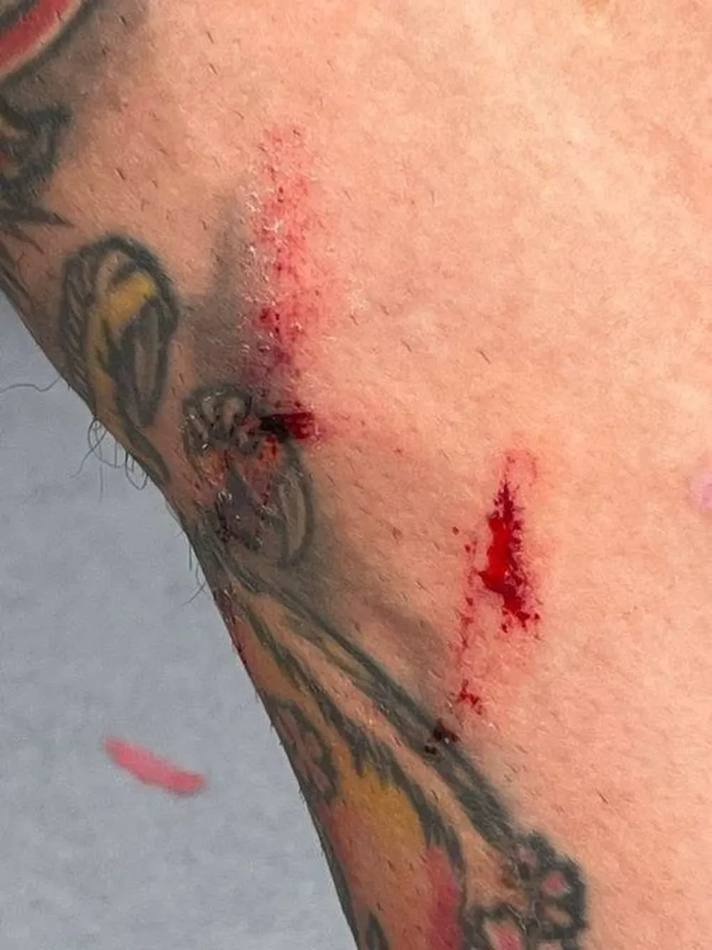 La pierna de Angel Correa