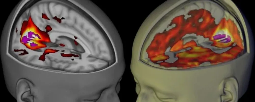 Resonancia magnética funcional de los cerebros de una persona bajo los efectos del LSD