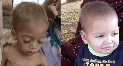 Niño mauritano desnutrido antes y después de tratamiento