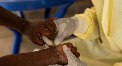 Un enfermero de laboratorio africano toma una muestra a un niño declarado caso sospechoso de Mpox&nbsp;