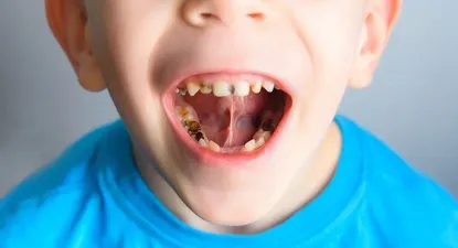 Cómo es el tratamiento para combatir la caries sin el temido taladro ni anestesia