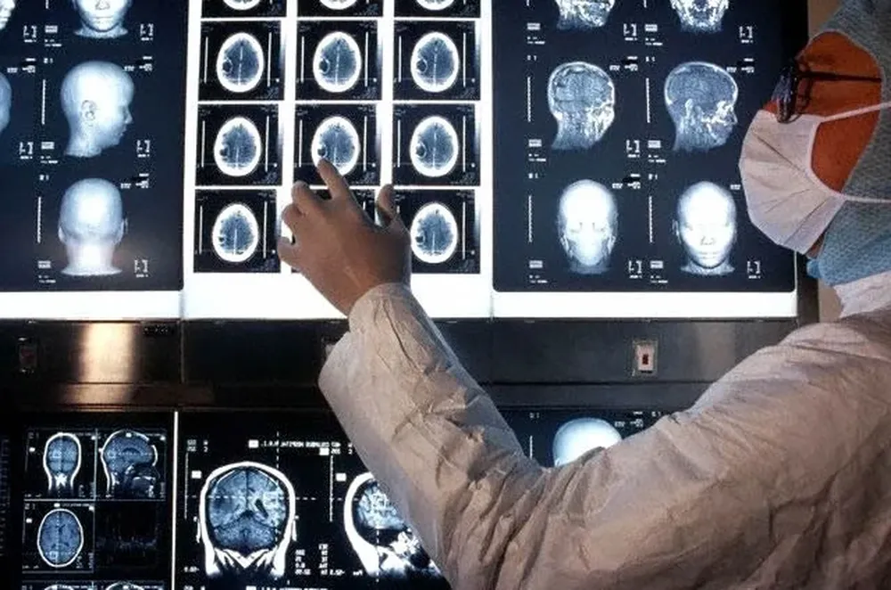 Médico observando placas de un paciente con esclerosis múltiple