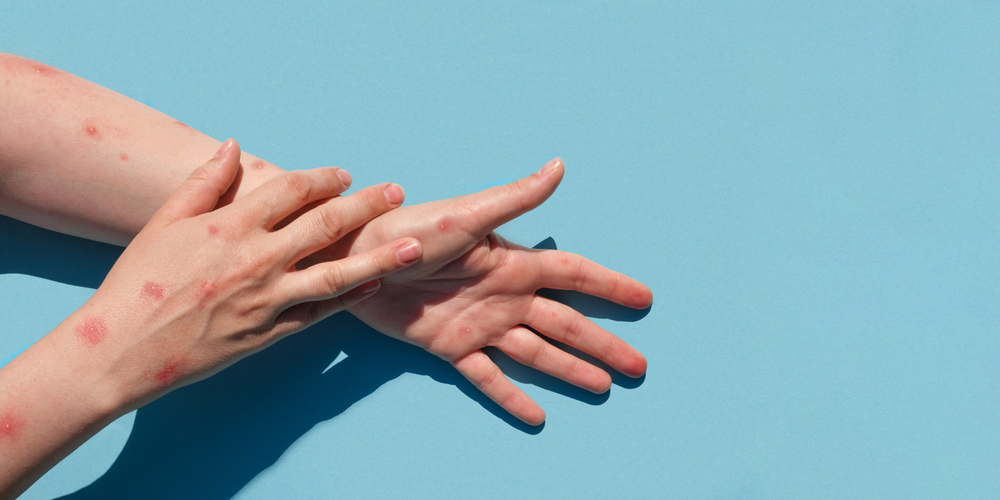 Se confirmó un caso positivo de viruela del mono en Argentina sin antecedentes de viaje