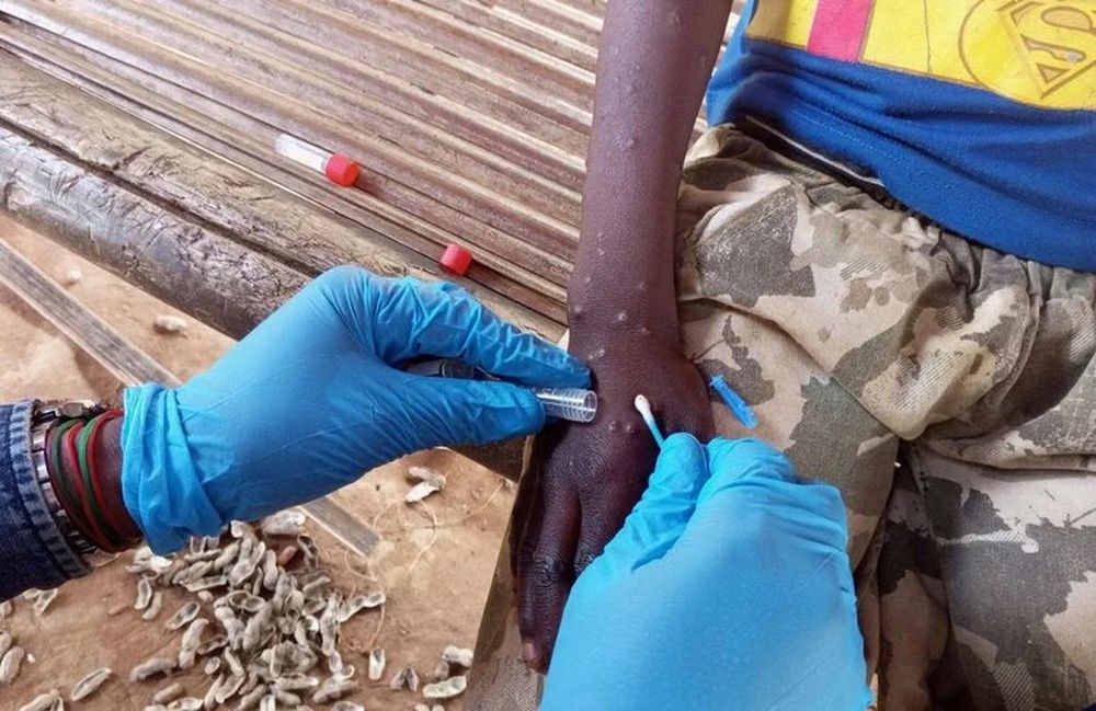 España y la UE refuerzan su estrategia sanitaria para contener la viruela del mono en 2024.  
