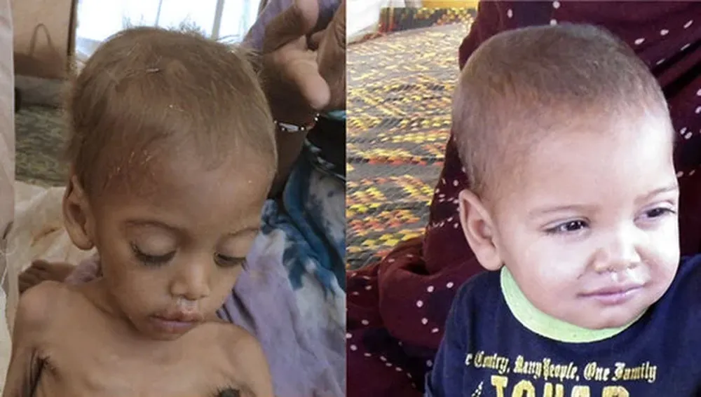 Niño mauritano desnutrido antes y después de tratamiento