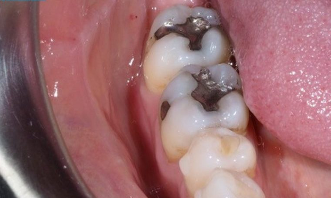 Uruguay prohibirá el uso de amalgamas dentales por impacto de mercurio en la salud y el ambiente