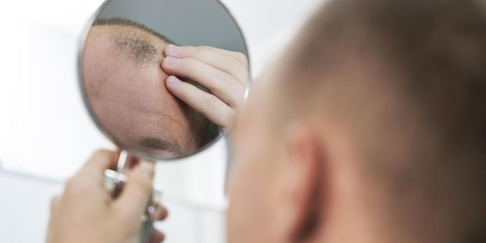 Alopecia severa