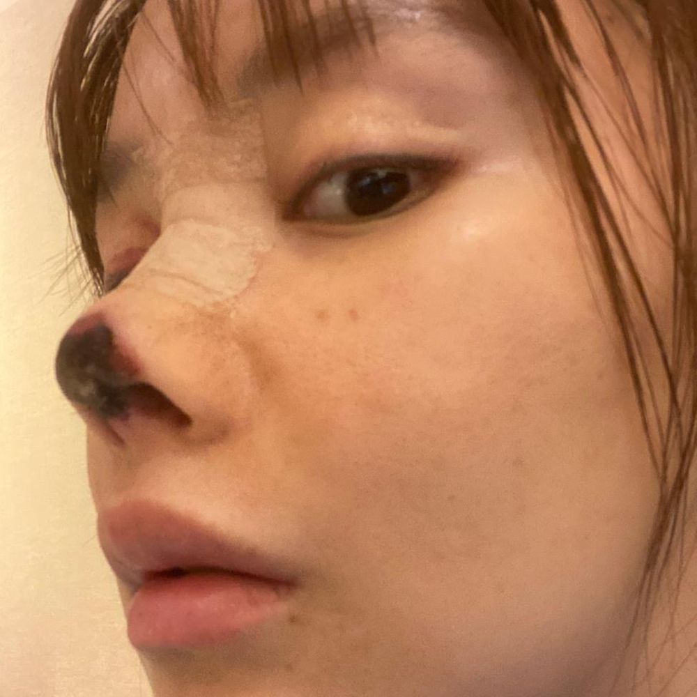 La operación de la actriz Gao Liu -en la que la punta de su nariz se volvió negra y murió- se hizo viral en 2020