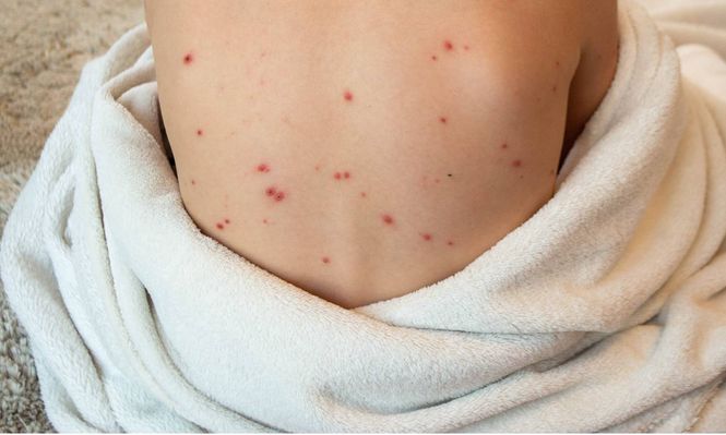 Sarampión en España: los expertos piden no alarmarse ya que el riesgo es bajo