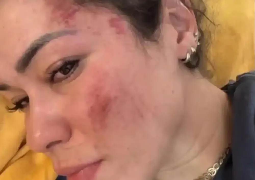 Las marcas del ataque a la española violada en India