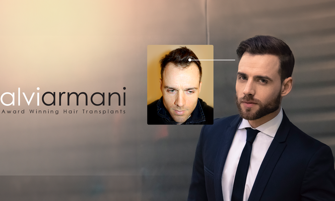 Alvi Armani: vanguardia y naturalidad en trasplante capilar, ahora en Montevideo