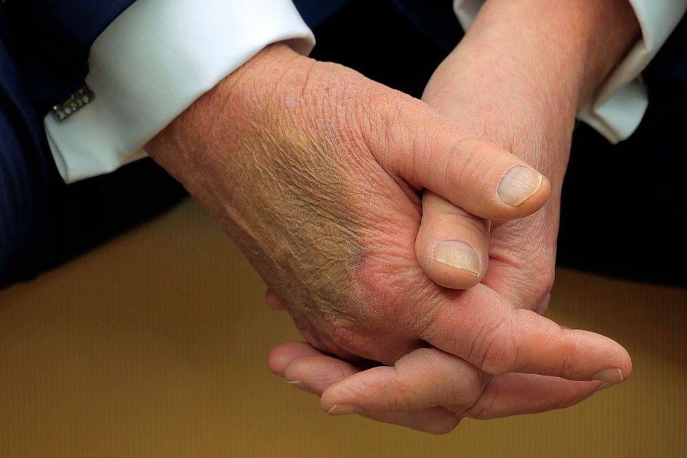 Una mano magullada del presidente ya había sido fotografiada durante una reunión con el presidente francés, Emmanuel Macron, en febrero.