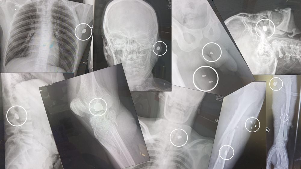 Radiografías de heridos de bala ingresados al hospital del Cerro