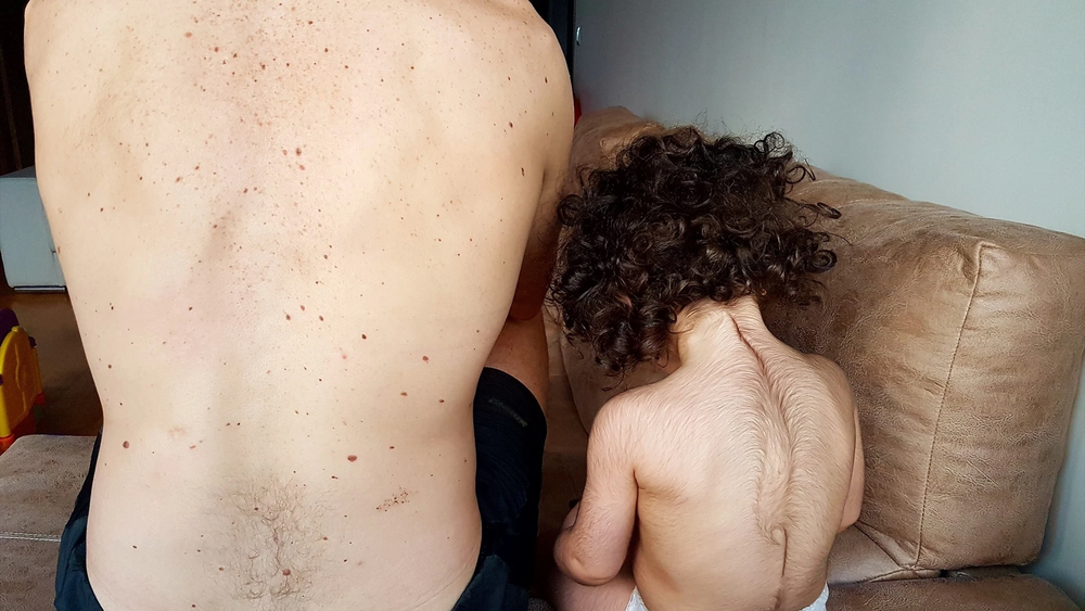 Un niño con hipertricosis, conocido popularmente como sindrome del hombre lobo