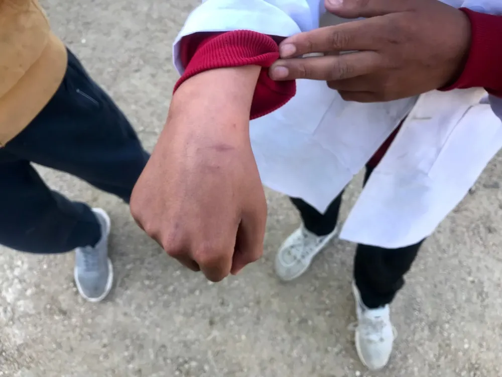 Archivo. Niño muestra cicatriz por juego realizado. Escuela N° 187 de Barros Blancos