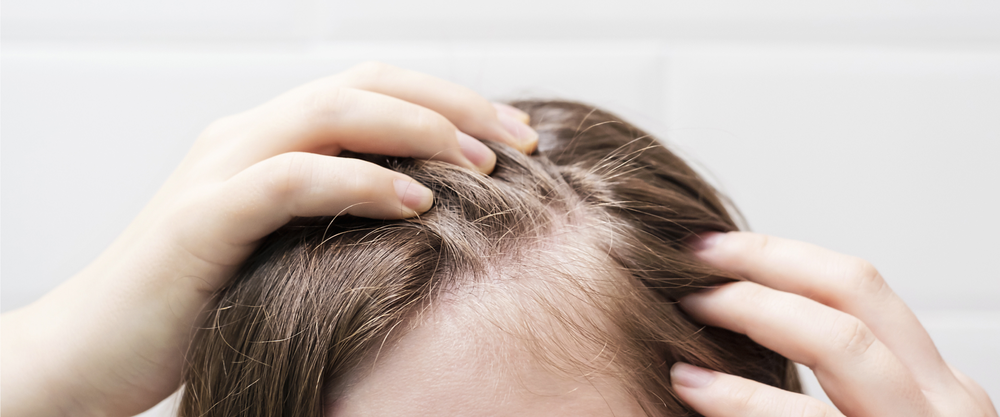 Alopecia severa