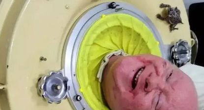 La increíble historia de Paul Alexander, el hombre que vivió por más tiempo que nadie con un pulmón de acero