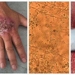 El Sporothrix brasiliensis visto en microscopio y su afectación a humanos y gatos