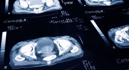 El de próstata es el cuarto cáncer más padecido a nivel mundial, según la Sociedad Estadounidense de Oncología Clínica