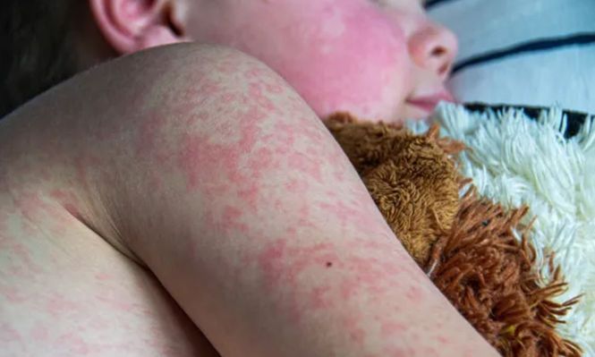 Brote de sarampión en Estados Unidos: suben los contagios y anticipan picos mayores a 2024, ¿cuáles son los síntomas y los estados en alerta?