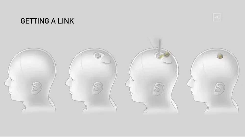 Dibujo de los diferentes pasos de la implantación del dispositivo interfaz de Neuralink en el cerebro.